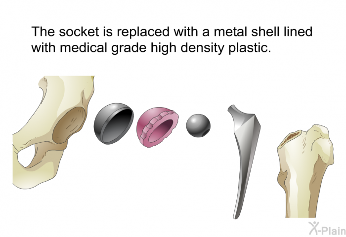 The socket is replaced with a metal shell lined with medical grade high density plastic.