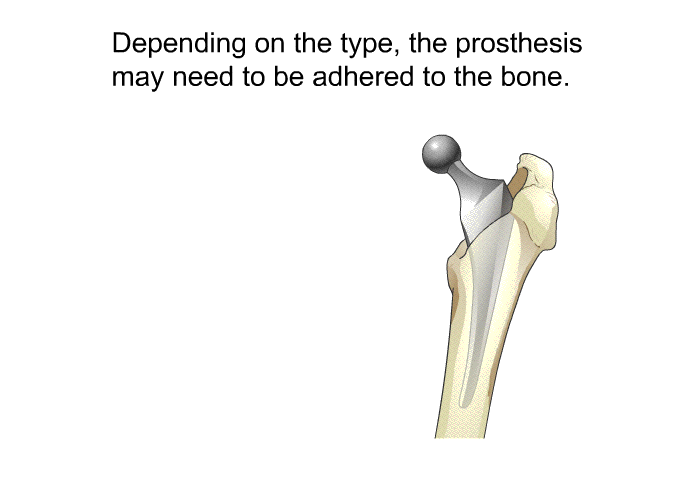 Depending on the type, the prosthesis may need to be adhered to the bone.