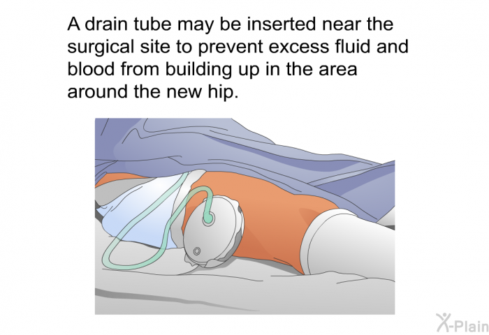 A drain tube may be inserted near the surgical site to prevent excess fluid and blood from building up in the area around the new hip.