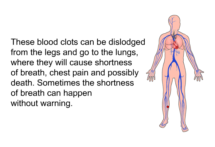 These blood clots can be dislodged from the legs and go to the lungs, where they will cause shortness of breath, chest pain and possibly death. Sometimes the shortness of breath can happen without warning.