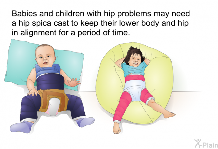 Babies and children with hip problems may need a hip spica cast to keep their lower body and hip in alignment for a period of time.