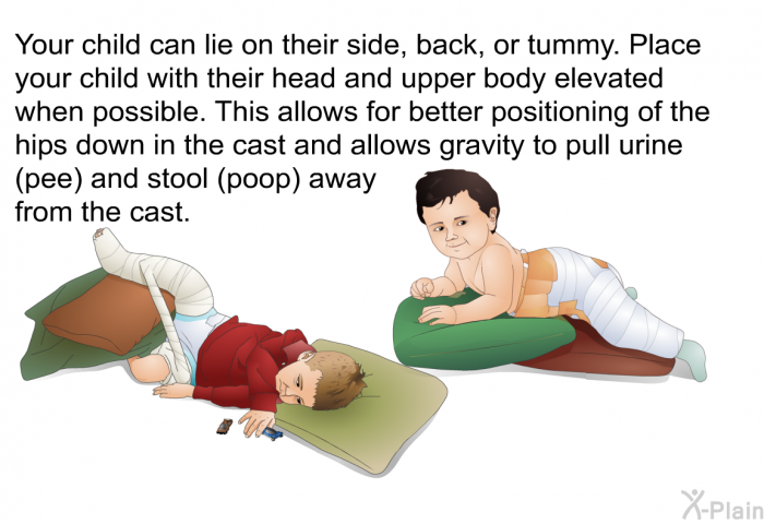 Your child can lie on their side, back, or tummy. Place your child with their head and upper body elevated when possible. This allows for better positioning of the hips down in the cast and allows gravity to pull urine (pee) and stool (poop) away from the cast.