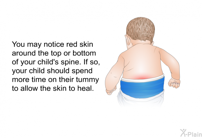You may notice red skin around the top or bottom of your child's spine. If so, your child should spend more time on their tummy to allow the skin to heal.
