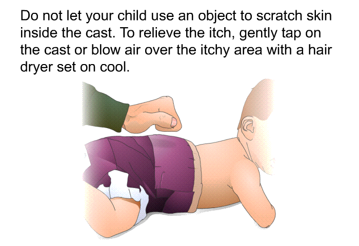 Do not let your child use an object to scratch skin inside the cast. To relieve the itch, gently tap on the cast or blow air over the itchy area with a hair dryer set on cool.