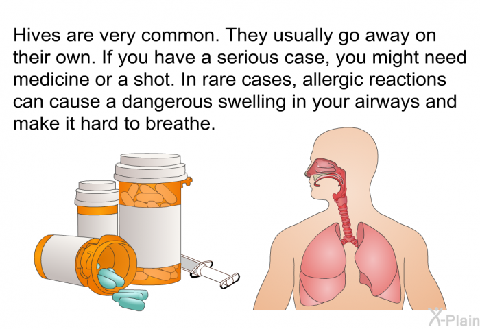 Hives are very common. They usually go away on their own. If you have a serious case, you might need medicine or a shot. In rare cases, allergic reactions can cause a dangerous swelling in your airways and make it hard to breathe.