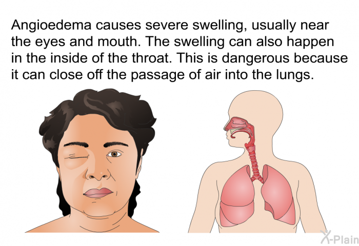 Angioedema causes severe swelling, usually near the eyes and mouth. The swelling can also happen in the inside of the throat. This is dangerous because it can close off the passage of air into the lungs.