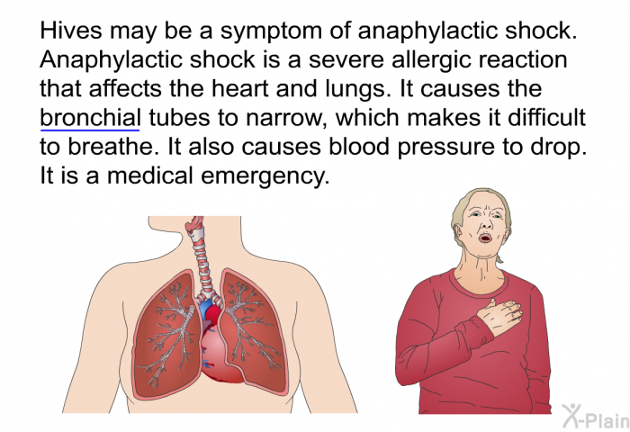 PatEdu Hives And Angioedema