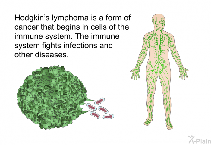 Hodgkin's lymphoma is a form of cancer that begins in cells of the immune system. The immune system fights infections and other diseases.