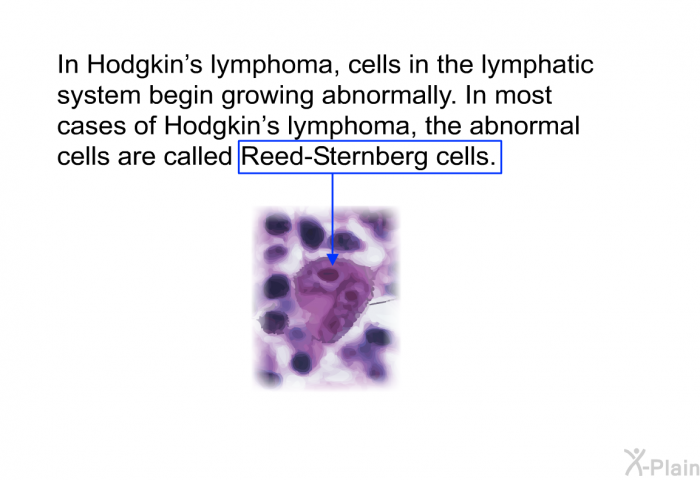 In Hodgkin's lymphoma, cells in the lymphatic system begin growing abnormally. In most cases of Hodgkin's lymphoma, the abnormal cells are called Reed-Sternberg cells.