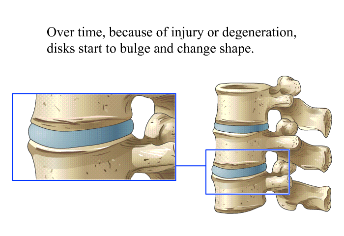 Over time, because of injury or degeneration, disks start to bulge and change shape.