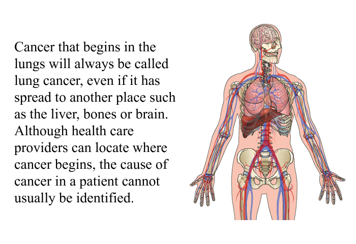 Cancer that begins in the lungs will always be called lung cancer, even if it has spread to another place such as the liver, bones or brain. Although health care providers can locate where cancer begins, the cause of cancer in a patient cannot usually be identified.