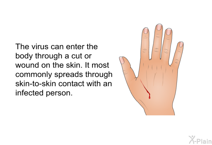 The virus can enter the body through a cut or wound on the skin. It most commonly spreads through skin-to-skin contact with an infected person.