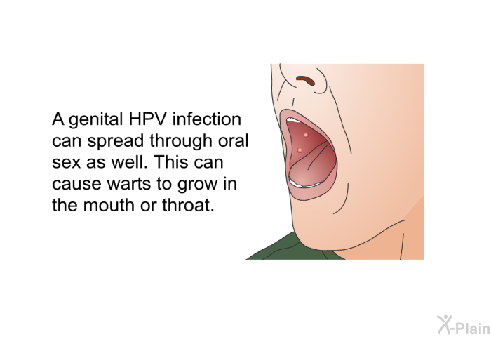 A genital HPV infection can spread through oral sex as well. This can cause warts to grow in the mouth or throat.