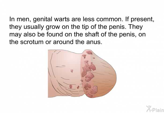 In men, genital warts are less common. If present, they usually grow on the tip of the penis. They may also be found on the shaft of the penis, on the scrotum or around the anus.