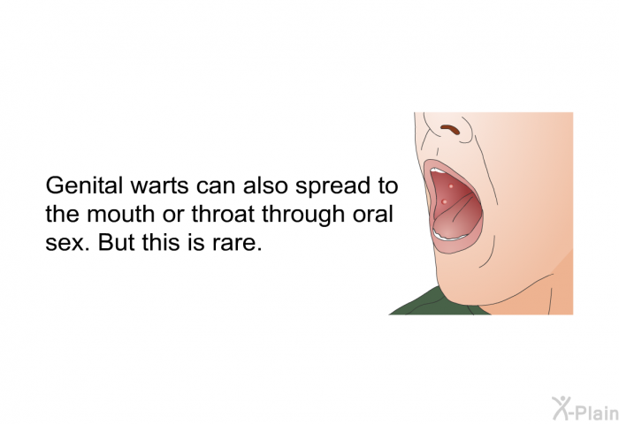 Genital warts can also spread to the mouth or throat through oral sex. But this is rare.