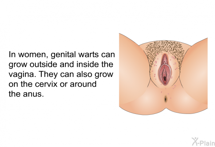 In women, genital warts can grow outside and inside the vagina. They can also grow on the cervix or around the anus.