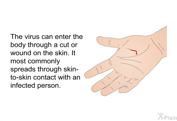 The virus can enter the body through a cut or wound on the skin. It most commonly spreads through skin-to-skin contact with an infected person.