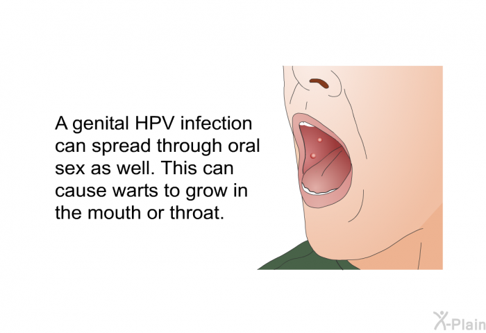 A genital HPV infection can spread through oral sex as well. This can cause warts to grow in the mouth or throat.