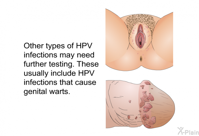 Other types of HPV infections may need further testing. These usually include HPV infections that cause genital warts.