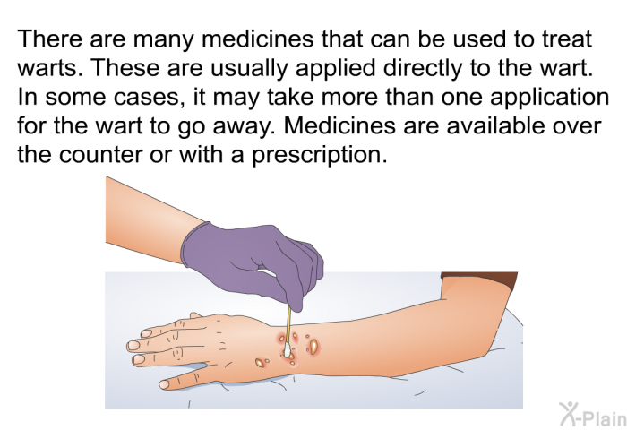 There are many medicines that can be used to treat warts. These are usually applied directly to the wart. In some cases, it may take more than one application for the wart to go away. Medicines are available over the counter or with a prescription.
