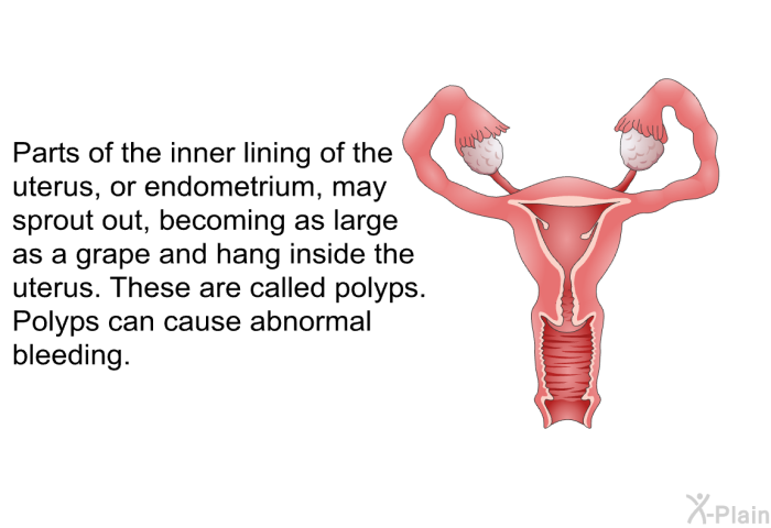 PatEdu Hydrothermal Endometrial Ablation