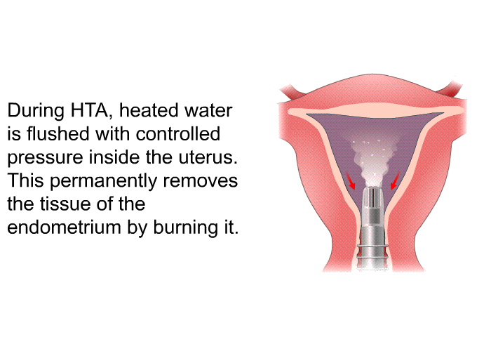 During HTA, heated water is flushed with controlled pressure inside the uterus. This permanently removes the tissue of the endometrium by burning it.