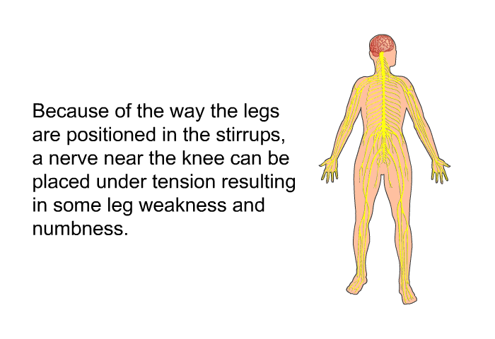Because of the way the legs are positioned in the stirrups, a nerve near the knee can be placed under tension resulting in some leg weakness and numbness.