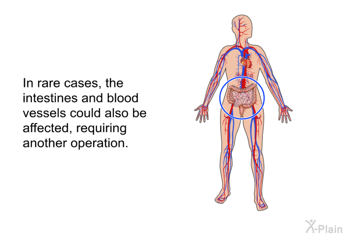 In rare cases, the intestines and blood vessels could also be affected, requiring another operation.
