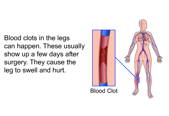 Blood clots in the legs can happen. These usually show up a few days after surgery. They cause the leg to swell and hurt.