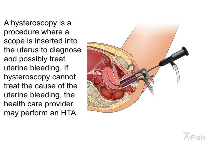 A hysteroscopy is a procedure where a scope is inserted into the uterus to diagnose and possibly treat uterine bleeding. If hysteroscopy cannot treat the cause of the uterine bleeding, the health care provider may perform an HTA.