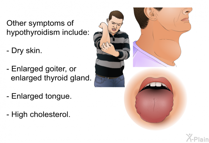 Other symptoms of hypothyroidism include:  Dry skin. Enlarged goiter, or enlarged thyroid gland. Enlarged tongue. High cholesterol.