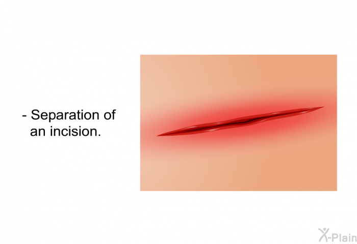 Separation of an incision.