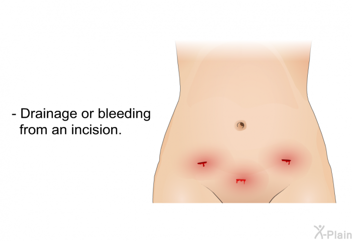 Drainage or bleeding from an incision.