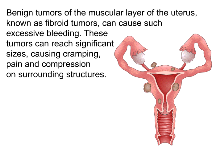 Benign tumors of the muscular layer of the uterus, known as fibroid tumors, can cause such excessive bleeding. These tumors can reach significant sizes, causing cramping, pain and compression on surrounding structures.