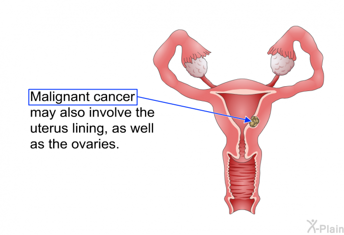 Malignant cancer may also involve the uterus lining, as well as the ovaries.