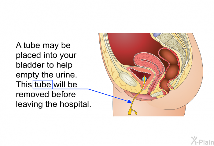 A tube may be placed into your bladder to help empty the urine. This tube will be removed before leaving the hospital.
