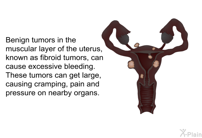 Benign tumors in the muscular layer of the uterus, known as fibroid tumors, can cause excessive bleeding. These tumors can get large, causing cramping, pain and pressure on nearby organs.