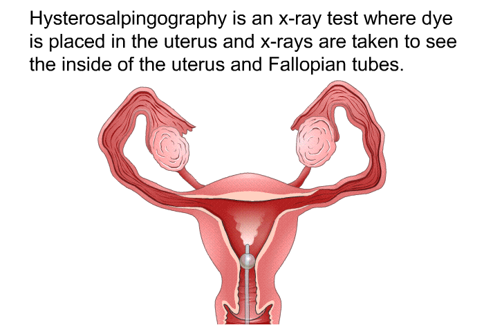 Hysterosalpingography is an x-ray test where dye is placed in the uterus and x-rays are taken to see the inside of the uterus and Fallopian tubes.