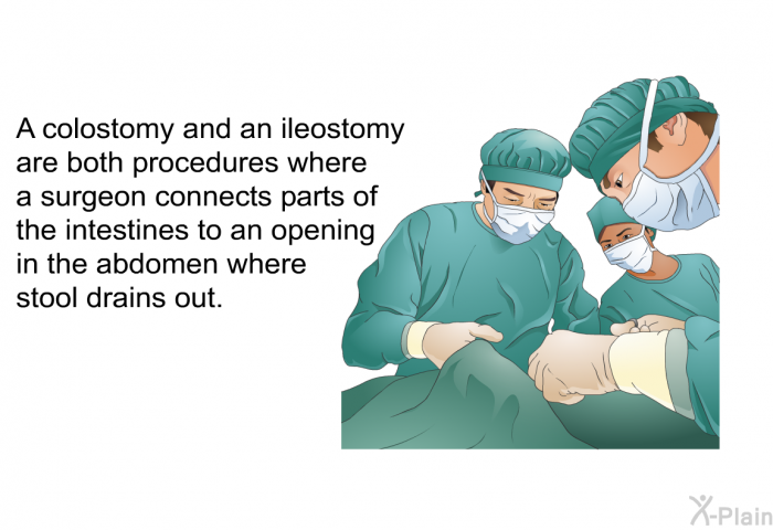 A colostomy and an ileostomy are both procedures where a surgeon connects parts of the intestines to an opening in the abdomen where stool drains out.