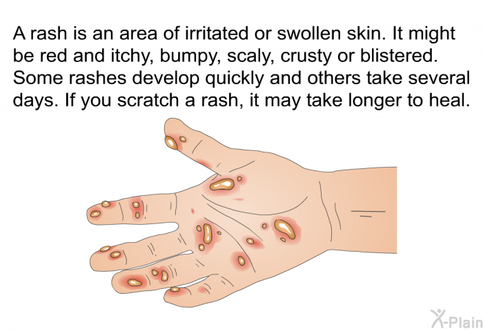 A rash is an area of irritated or swollen skin. It might be red and itchy, bumpy, scaly, crusty or blistered. Some rashes develop quickly and others take several days. If you scratch a rash, it may take longer to heal.