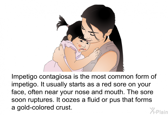 Impetigo contagiosa is the most common form of impetigo. It usually starts as a red sore on your face, often near your nose and mouth. The sore soon ruptures. It oozes a fluid or pus that forms a gold-colored crust.