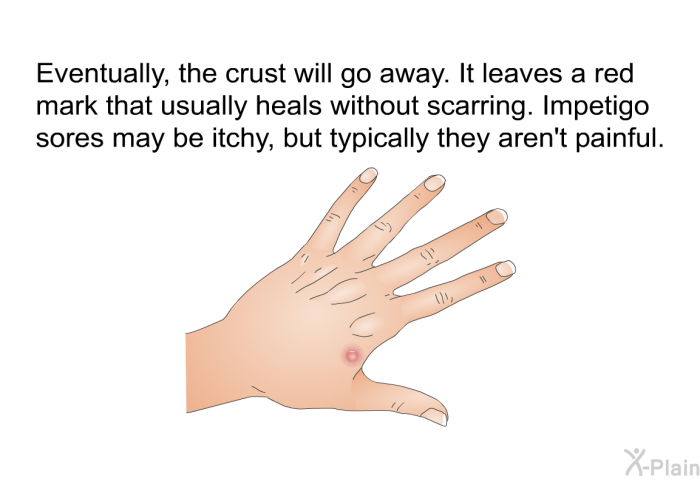 Eventually, the crust will go away. It leaves a red mark that usually heals without scarring. Impetigo sores may be itchy, but typically they aren't painful.