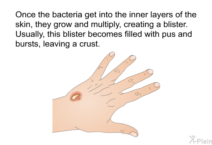 Once the bacteria get into the inner layers of the skin, they grow and multiply, creating a blister. Usually, this blister becomes filled with pus and bursts, leaving a crust.
