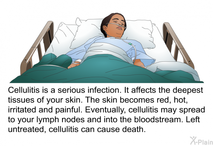 Cellulitis is a serious infection. It affects the deepest tissues of your skin. The skin becomes red, hot, irritated and painful. Eventually, cellulitis may spread to your lymph nodes and into the bloodstream. Left untreated, cellulitis can cause death.