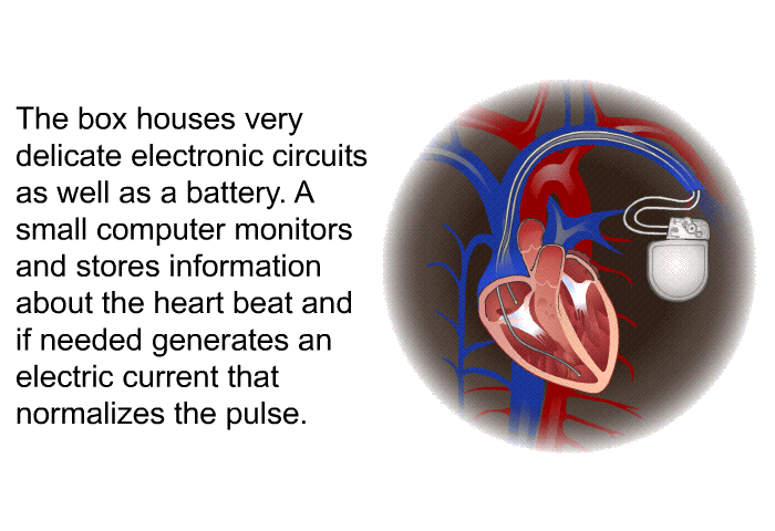 The box houses very delicate electronic circuits as well as a battery. A small computer monitors and stores information about the heart beat and if needed generates an electric current that normalizes the pulse.