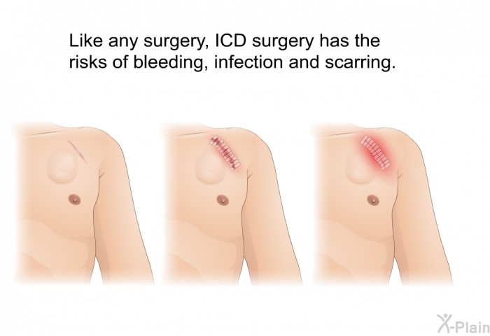 Like any surgery, ICD surgery has the risks of bleeding, infection and scarring.