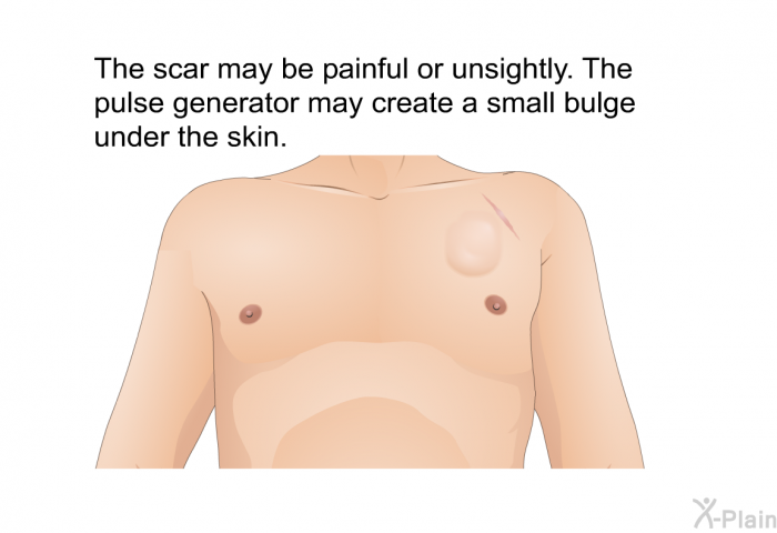 The scar may be painful or unsightly. The pulse generator may create a small bulge under the skin.