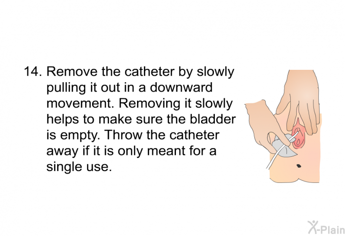 <OL START=17> Remove the catheter by slowly pulling it out in a downward movement. Removing it slowly helps to make sure the bladder is empty. Throw the catheter away if it is only meant for a single use.