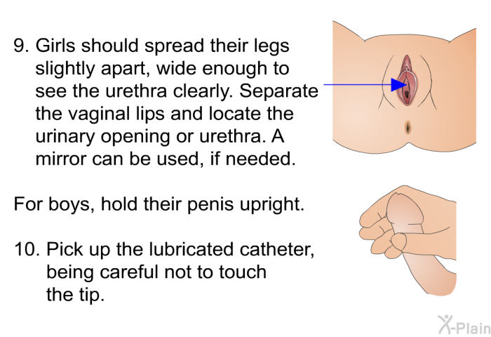 Girls should spread their legs slightly apart, wide enough to see the urethra clearly. Separate the vaginal lips and locate the urinary opening or urethra. A mirror can be used, if needed. For boys, hold their penis upright. Pick up the lubricated catheter, being careful not to touch the tip.