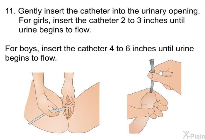 <OL START=13> Gently insert the catheter into the urinary opening. For girls, insert the catheter 2 to 3 inches until urine begins to flow. For boys, insert the catheter 4 to 6 inches until urine begins to flow.